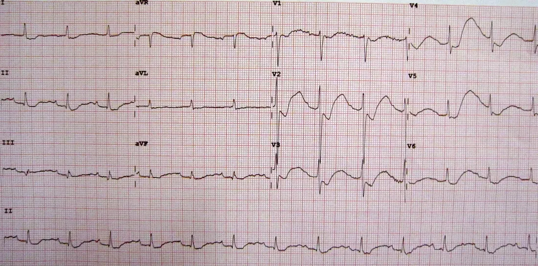 A twelve-lead ECG printout on grid paper. The traces show shallow, flattened T waves followed by an extra rounded deflection, with the segment before each T wave dipping below the baseline.