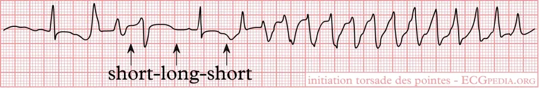 A single-lead ECG rhythm strip. Three arrows mark a normal beat, an early beat and a pause, annotated short-long-short. Immediately afterwards the trace breaks into a rapid run of beats of continually changing height.