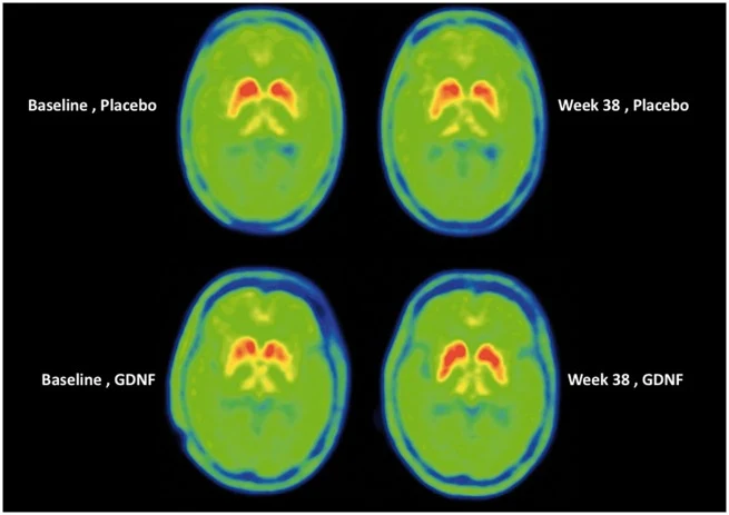 Four colour-coded PET brain slices in two rows. The top row, labelled placebo at baseline and at week 38, shows two small red patches that look much the same in both. The bottom row, labelled GDNF, shows the same patches noticeably larger and more intensely red at week 38 than at baseline.